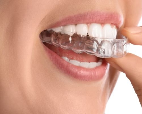Invisible Aligner